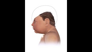 What is Microcephaly Causes Symptoms Treatment [upl. by Driscoll514]