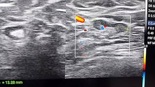 Axillary lymph nodes on ultrasound [upl. by Irved724]