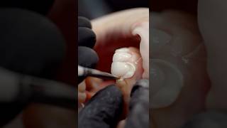 Applying new veneers enhances teeth’s appearance instantly dental dentist satisfying [upl. by Ingamar]