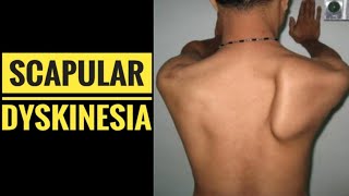 Scapular Dyskinesia or Sick Scapula Syndrome due to ACJ Dislocation [upl. by Anyrb]