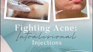 Fighting Acne Intralesional Injections [upl. by Jorgensen983]