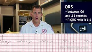 Bradycardia ECG Rhythm Interpretation [upl. by Hapte]