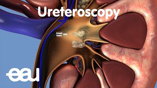 Removal of kidney stones URS [upl. by Ahsiak]