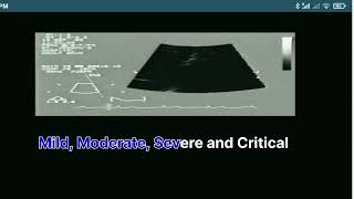 Mitral Stenosis Echo Stages [upl. by Keyser358]