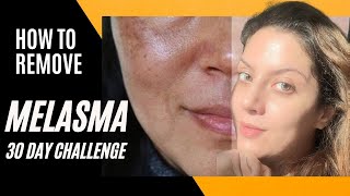 Melasma Removal at Home I Melasma Remove cream I Melasma Skin Care Regimen Routine [upl. by Ailisab]