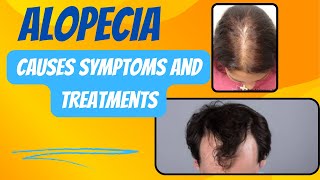 Alopecia causessymptoms and treatments। Alopecia Areata। preferred solution [upl. by Dorahs]