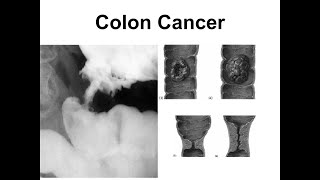 Colon cancer [upl. by Olpe193]