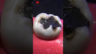 Restauración dental satisfying [upl. by Weinert]