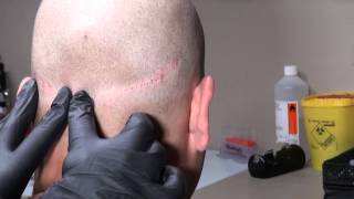 Micro Hair Pigmentation MHP van FUT litteken bij Beauty Care Nederland BCN te Katwijk [upl. by Odracir418]