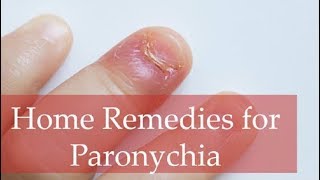 Top 6 Home Remedies for Paronychia and Best Home Treatment Methods [upl. by Seraphim299]