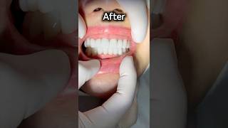 full mouth reconstruction deepbite correction smile dentist dental [upl. by Adnimra]