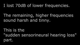 What does diplacusis and Sudden Sensorineural Hearing Loss sound like due to Cochlear Hydrops [upl. by Ebneter]