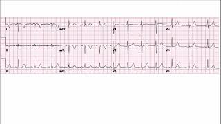 Lead reversal and Dextrocardia ECG explanation [upl. by Avaria623]