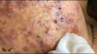 Blackhead Whitehead Removal  Cystic Acne Treatment  Elderly Pimple Popping  Facial Acne Spa 082 [upl. by Smada]