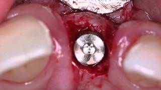 How to extract a tooth with severe resorption [upl. by Einaffit]