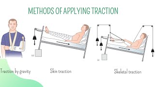 Splints and Tractions  Orthopedics  Concise presentation for medical students [upl. by Gilges]