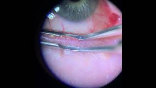 Meibomian Gland Expression Upper and Lower Lid [upl. by Rimma280]