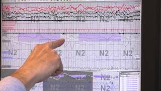 Reading Sleep Study Results Identifying Sleep Apnea [upl. by Losyram335]