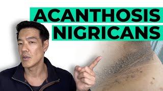 How to treat Acanthosis Nigricans  Dr Davin Lim [upl. by Oeniri]