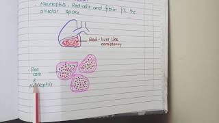 Lobar Pneumonia And Bronchopneumonia  Pathology [upl. by Kenric935]