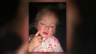 Minn todler born with rare allergy to water [upl. by Nesila]