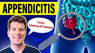 Doctor explains APPENDICITIS  Causes symptoms and treatment [upl. by Oirazan15]