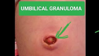 what is umbilical granuloma how to cure it [upl. by Marsh225]