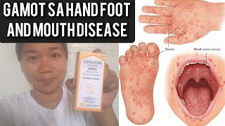 hand foot and mouth disease treatment handfootmouthdisease skininfection [upl. by Graybill]