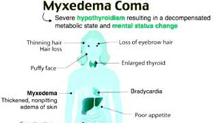 Myxedema comahypothyroidism [upl. by Conlon]