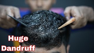 Huge Dandruff Removal From Dry Sculp  ASMR Dandruff Treatment amp Massage  Dandruff Scratching ASMR [upl. by Jariv]