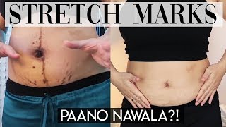 NO MORE STRETCHMARKS Paano Nawala  Kris Lumagui [upl. by Snehpets580]