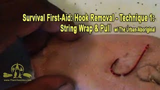 FirstAid Hook Removal  Technique  String Wrap amp Pull [upl. by Sineray]