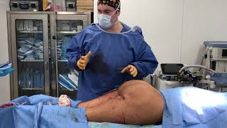 Massive Silicone Injection Removal From Butt with Dr Kenneth Hughes Los Angeles Plastic Surgeon [upl. by Tannenwald149]