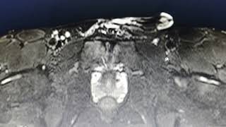 Osteitis pubis  MRI findings [upl. by Assiralk544]