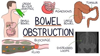 Understanding Bowel Obstruction [upl. by Ranchod]