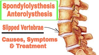 Spondylolisthesis or Anterolisthesis Causes symptoms and Treatment in UrduHindi [upl. by Ainolopa]