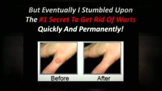 How To Get Rid Of Plantar Warts  1 Secret [upl. by Sheri665]