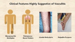 Vasculitis  An Overview [upl. by Eatnahc]