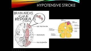 Cerebrovascular Disease Part 2 [upl. by Swerdna775]