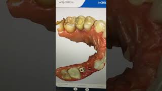 🦷 Digital Impressions for Implant 🔥 [upl. by Cesaria]