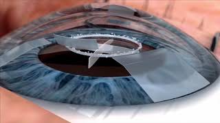 Watch live surgery using the laser cataract system  how does it work Eye News TV [upl. by Adnawahs219]