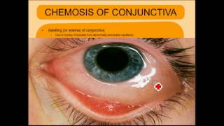 ENDOPHTHALMITIS SIMPLIFIED [upl. by Naaman]