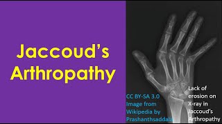 Jaccoud’s Arthropathy [upl. by Olds103]