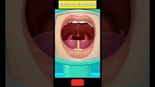 Removal of tonsils tonsilitis tonsils tonsilstones facts [upl. by Janeva972]