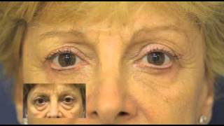 Blefaroplastia antes y después Dr M Devoto buenos Aires [upl. by Nwahc199]