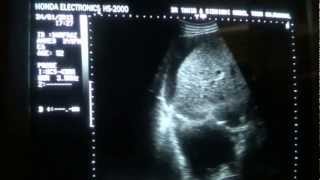 ASCITIC vs PLEURAL FLUID differentiation by ultrasound [upl. by Aztiram]