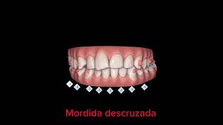 TRATAMENTO COM INVISALIGN  MORDIDA CRUZADA [upl. by Ferrigno]