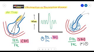 FEV1FVC ratio in Obstructive vs Restrictive diseases  RS physiology  Med Madness [upl. by Hterrag]