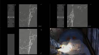 Balloon angioplasty and stenting of severe carotid stenosis [upl. by Morissa845]