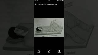 Lithotomy position [upl. by Terena]